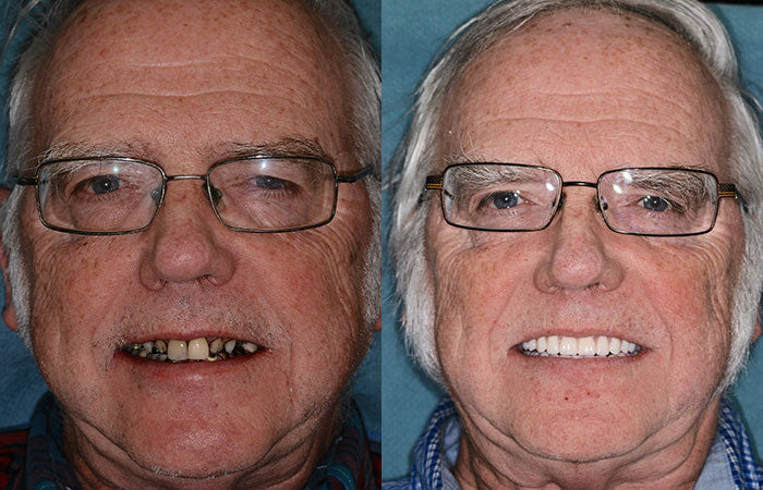 Thermabuild | Advanced Customized Full Denture Set (⏰Limited time discount last 30 minutes⏰)