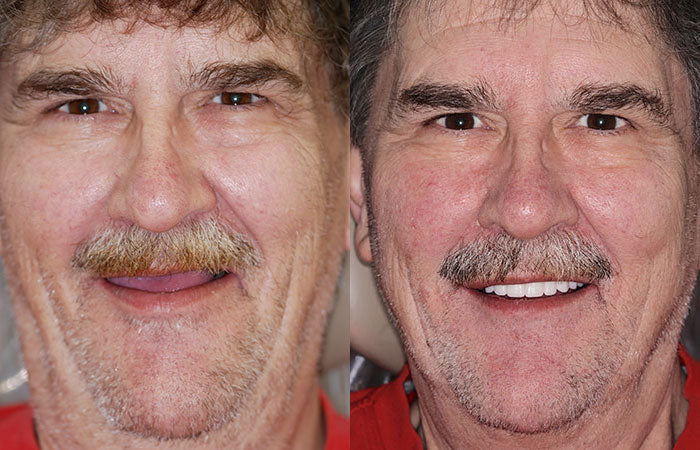 Thermabuild | Advanced Custom Full Denture Set