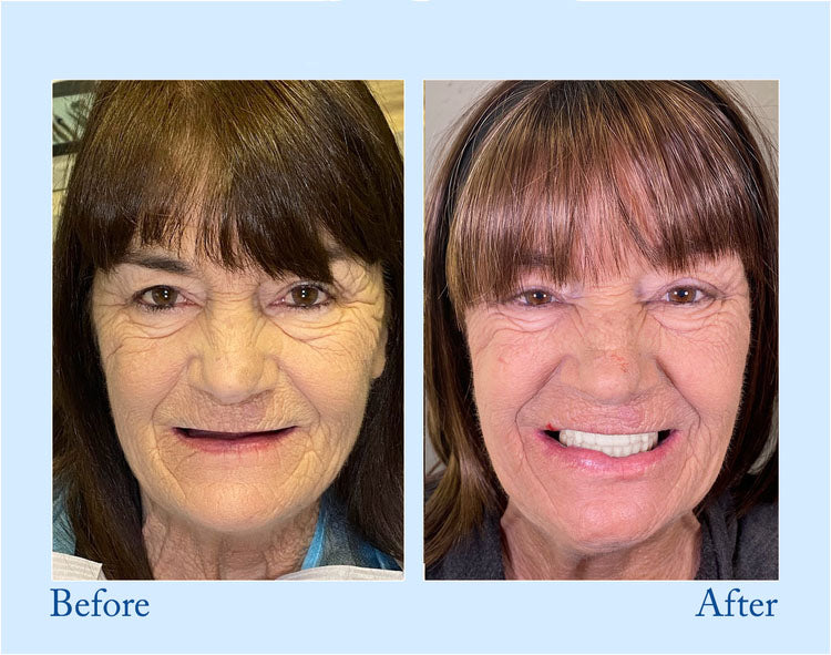 Thermabuild | Premium Denture