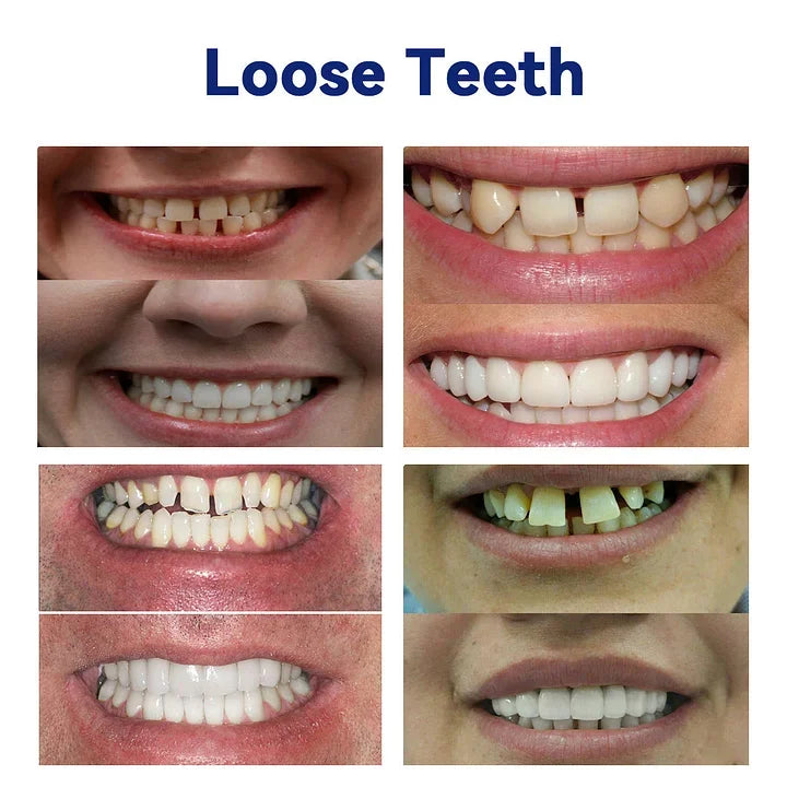 Thermabuild | New Generation Flexible Full Denture Solution