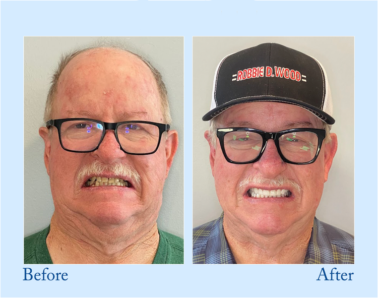 Thermabuild | Premium Denture