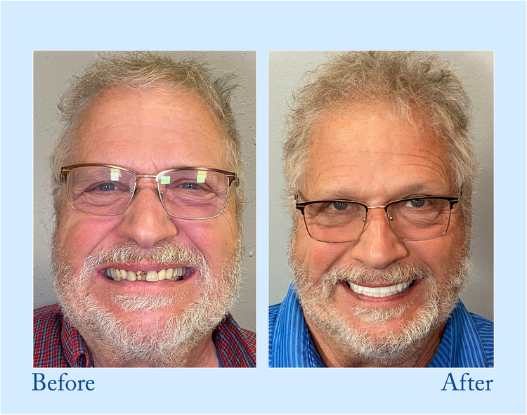 Thermabuild | Premium Denture