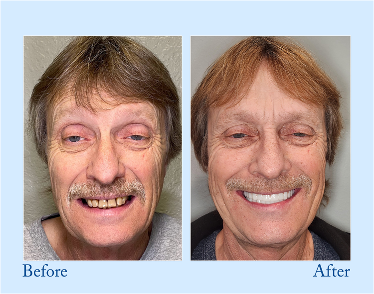 Thermabuild | Premium Denture