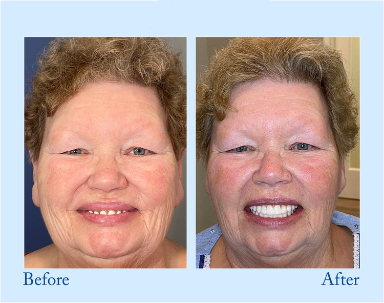 Thermabuild | Premium Denture