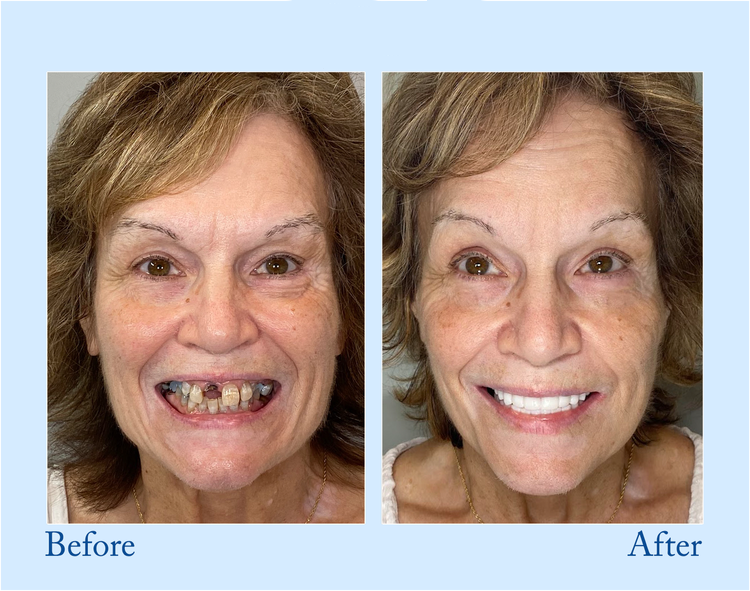 Thermabuild | Premium Denture