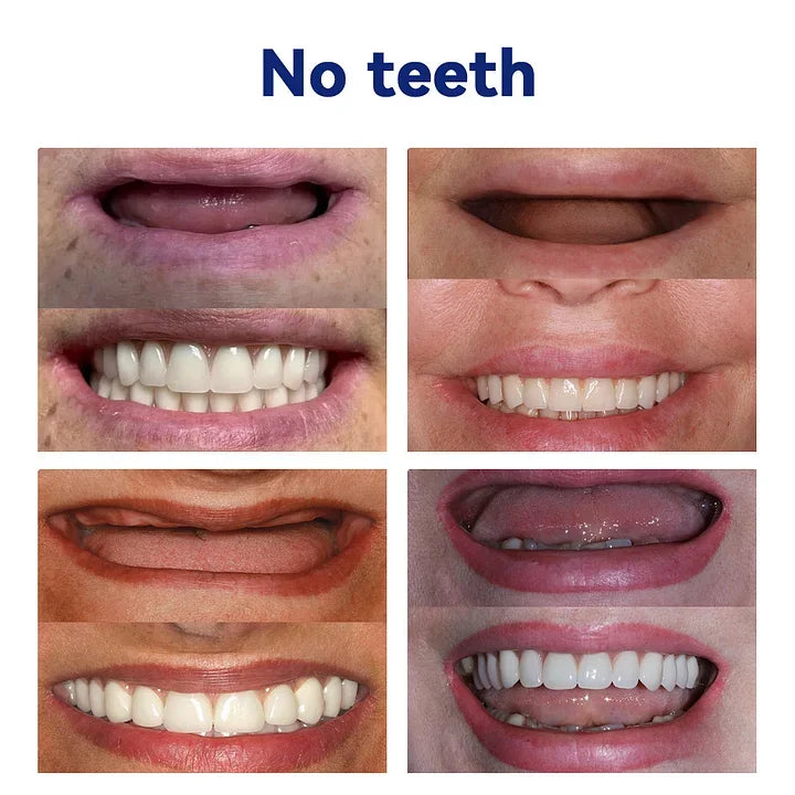 Thermabuild | Flexible Full Denture