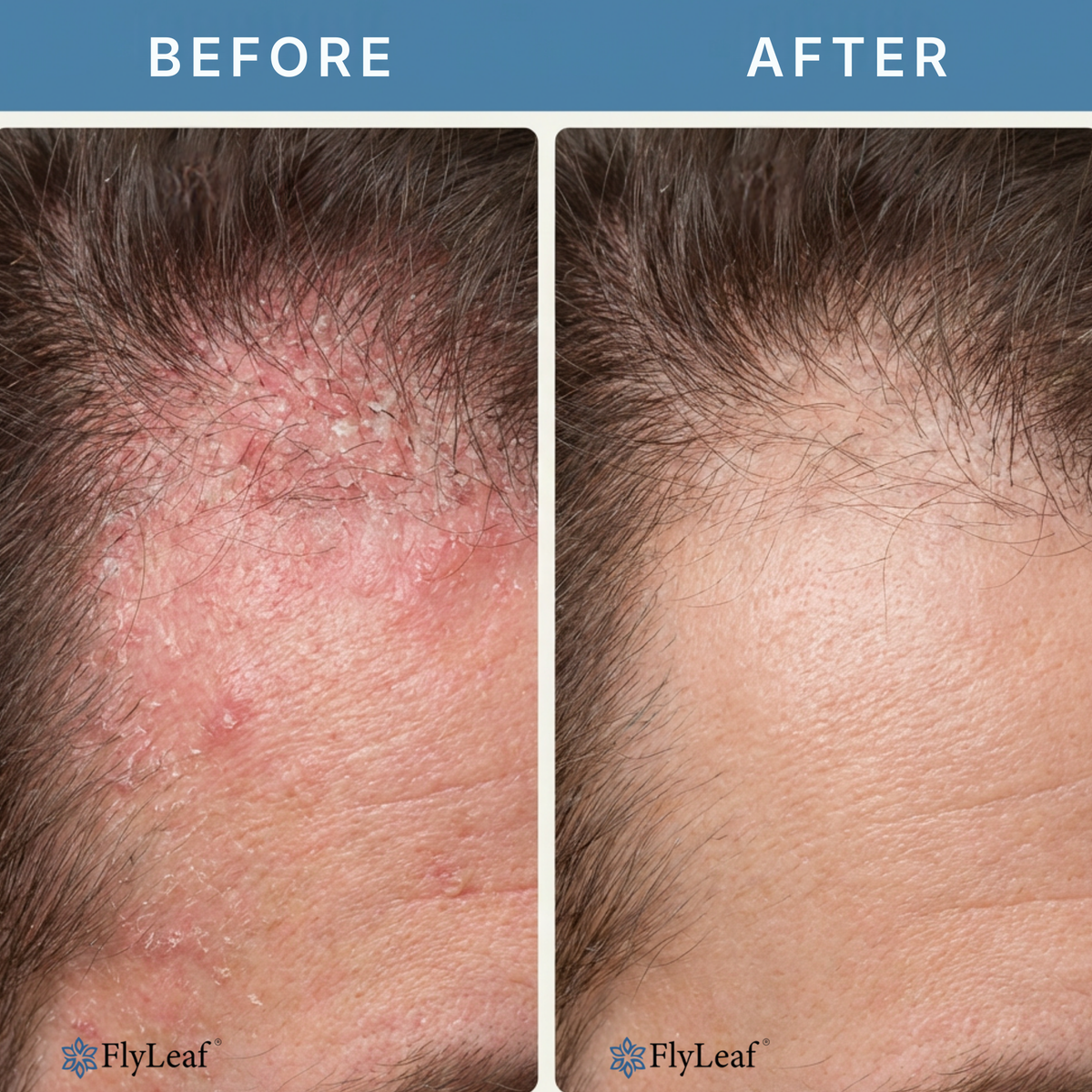 Thermabuild | Soothing Scalp and Beard Irritation Relief Cream - Steroid-Free Skin Treatment for Redness and Flaking - Dermatology-Inspired Care for Men