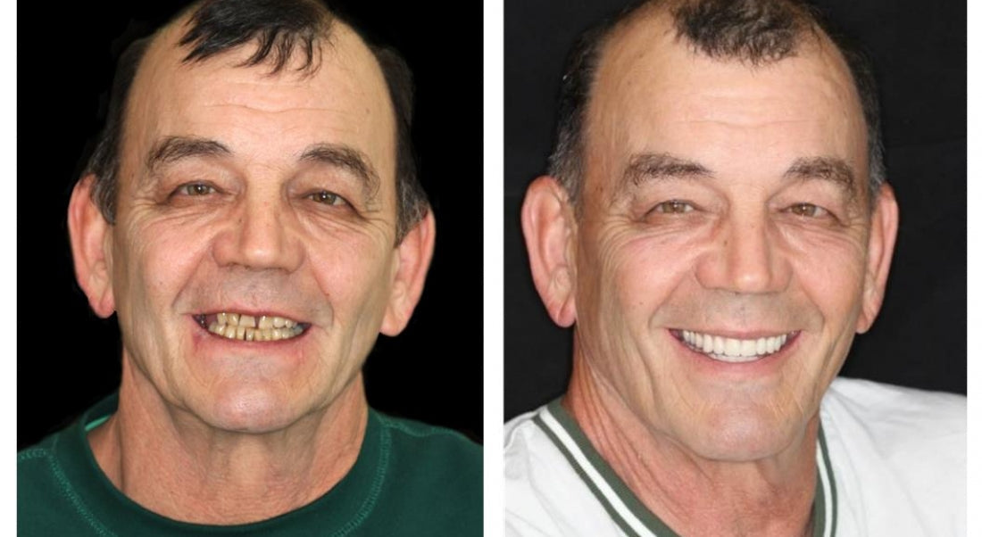 Thermabuild | Advanced Customized Full Denture Set (⏰Limited time discount last 30 minutes⏰)
