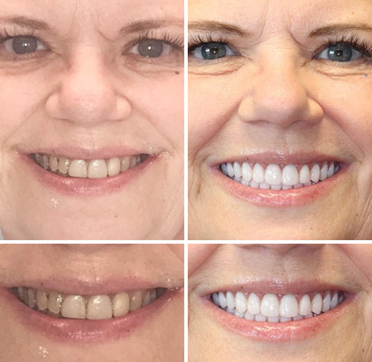 Thermabuild | Advanced Customized Full Denture Set (⏰Limited time discount last 30 minutes⏰)