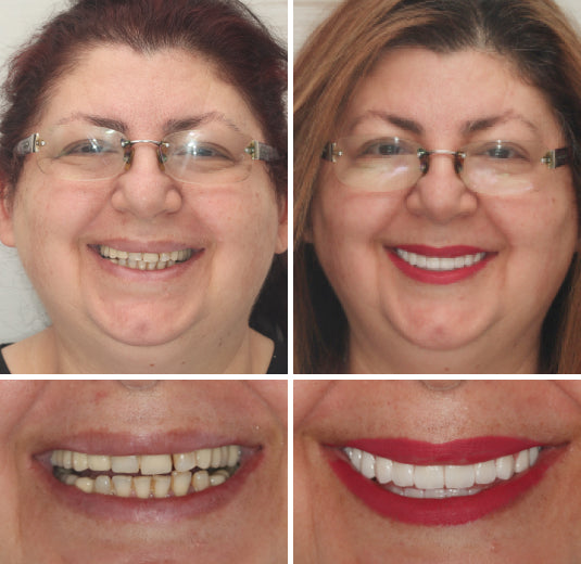 Thermabuild | Advanced Custom Full Denture Set