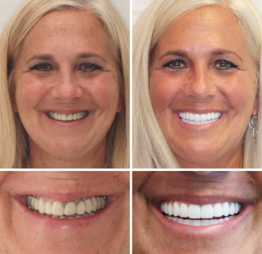 Thermabuild | Advanced Custom Full Denture Set