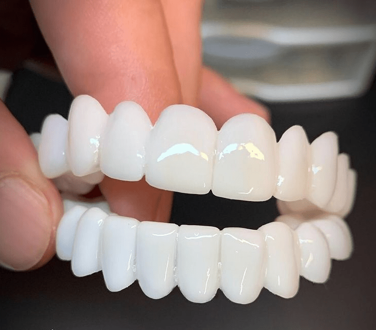 Thermabuild | Natural-Look Dental Veneer for Everyday Confidence