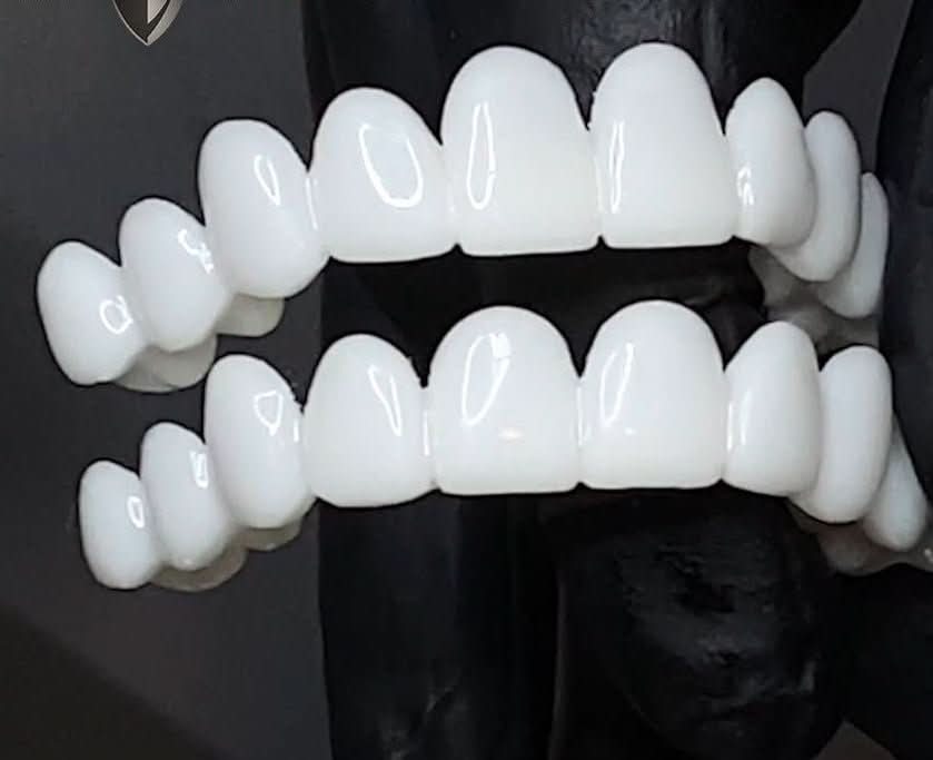 Thermabuild | Natural-Look Dental Veneer for Everyday Confidence